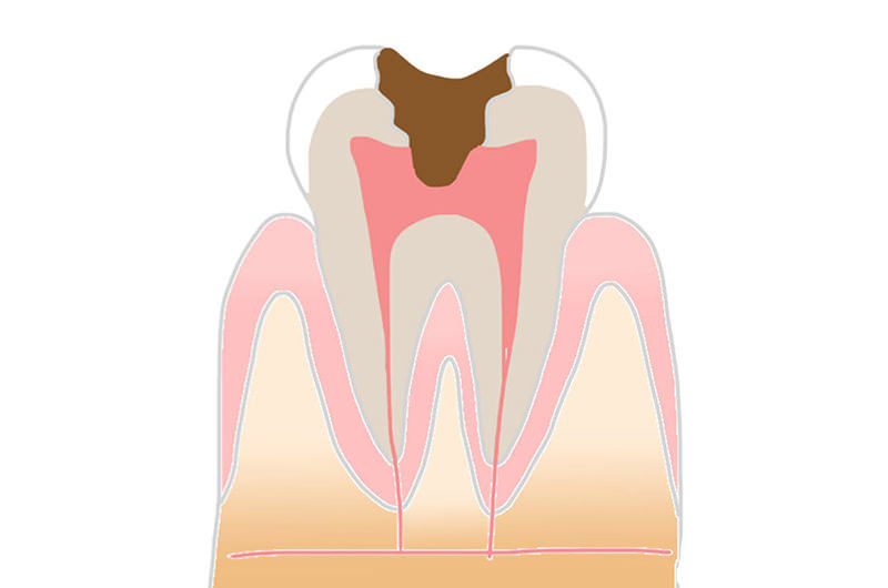 C3(歯の神経のむし歯)