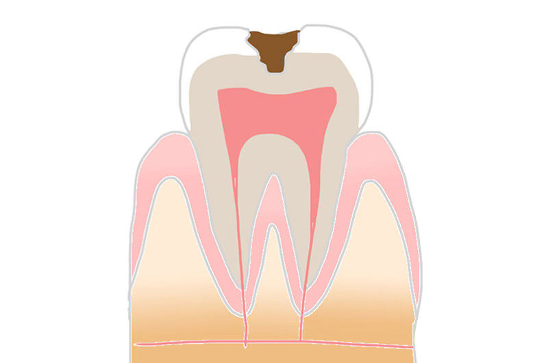 C2(象牙質のむし歯)